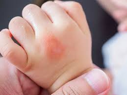 keeping kids safe from ticks Fort Wayne