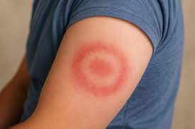 Lymes disease is deadly