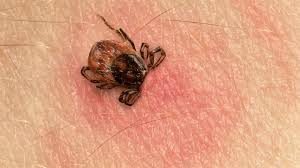 Tick bite 