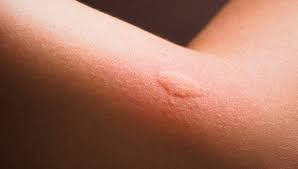 economic cost of mosquitoes